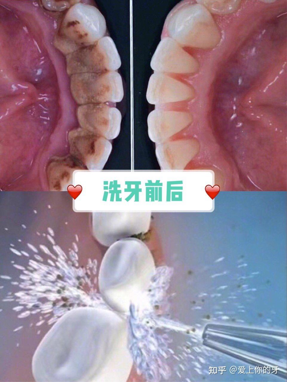 安康洗牙可以用医保吗(洗牙可以用医保吗,报销比例多少)